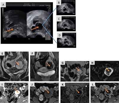 Abnormal Elevation of Anti-Mullerian Hormone and Androgen Levels Presenting as Granulosa Cell Tumor